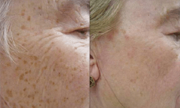 IPL Pigmentation Reduction and Removal, Beauty salon in Bolton, Beauty By Sonia