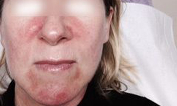 IPL Rosacea Treatment before image of client, Beauty By Sonia, Bolton